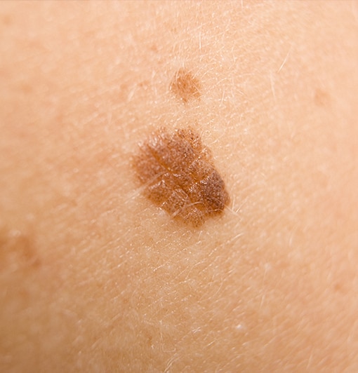 dermatoscope