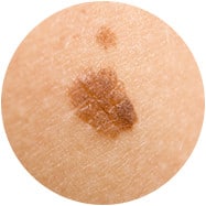 Dermatoscopie